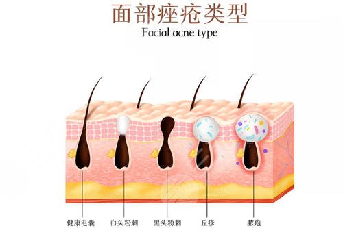 红光治疗痤疮几次见?