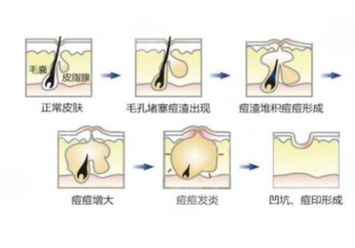 脸上长痘印如何消除?