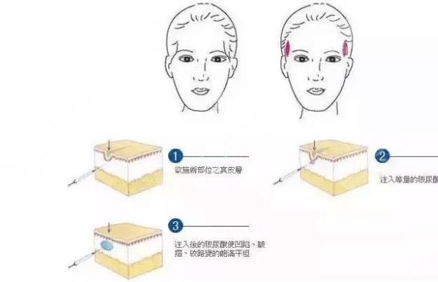 玻尿酸丰太阳穴