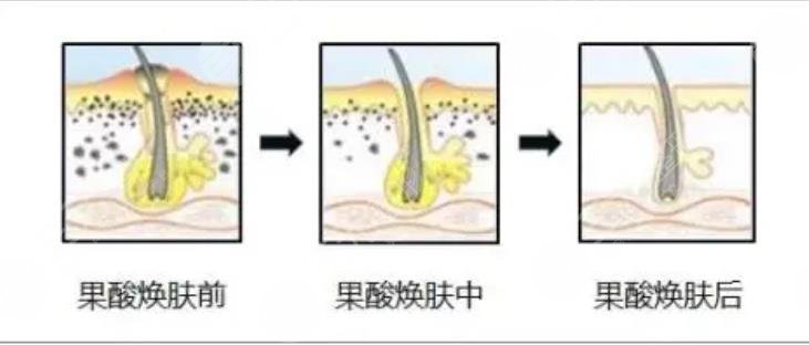 去黑头