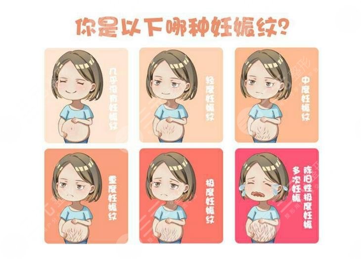 如何消除妊娠纹?