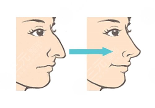 驼峰鼻整形的价格是多少?