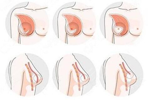 丰胸方法有哪些?