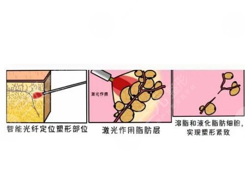 光纤溶脂瘦小腿果好吗?