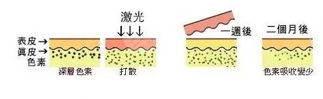 激光美白有副作用吗?