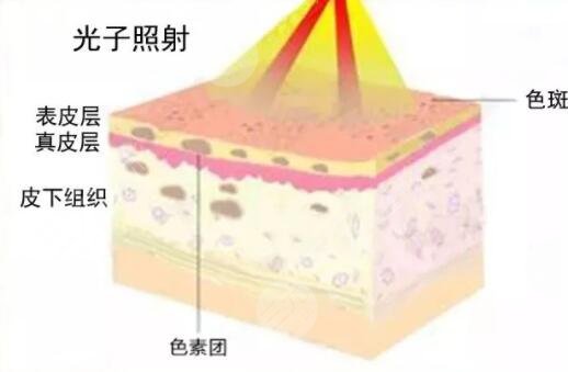 彩光嫩肤有副作用吗?