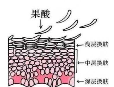 果酸嫩肤