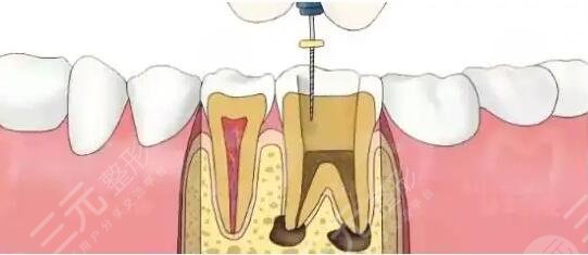 根管治疗后悔一辈子是真的吗？为什么会后悔？根管治疗果可以维持多久？