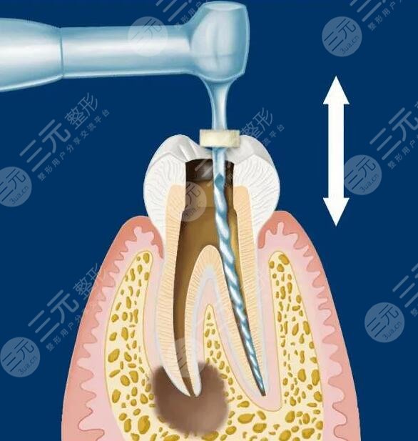 根管治疗