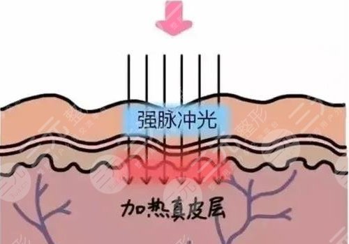 光子嫩肤美白果好么?