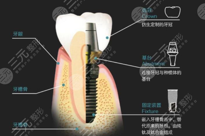 牙齿种植