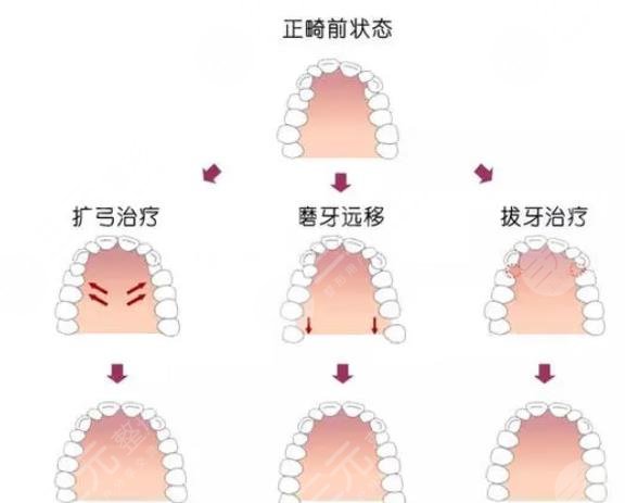 牙齿矫正35岁还可以吗