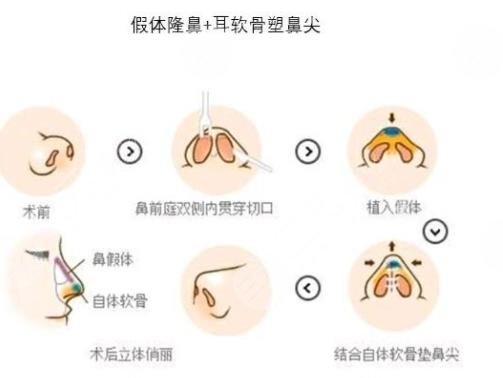 耳软骨隆鼻