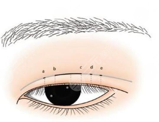 双眼皮