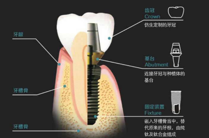 牙齿种植