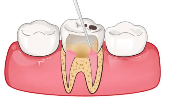 根管治疗