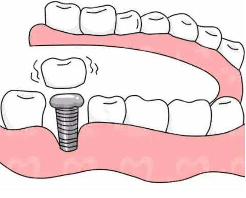 上海美奥口腔医院种植牙案例