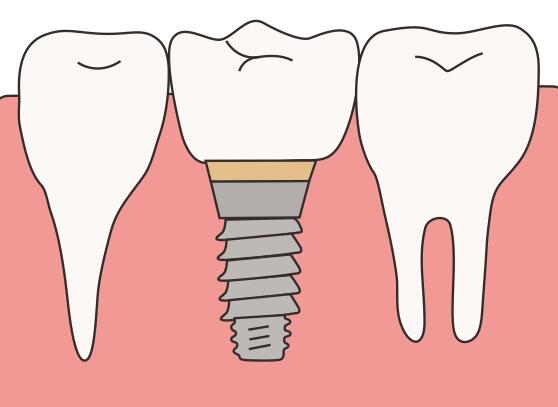 种植牙