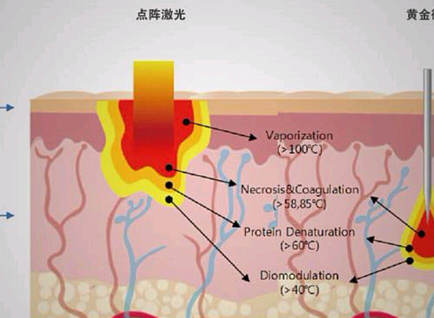 上海华山医院点阵激光案例