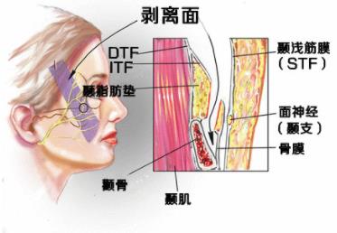 面部提升